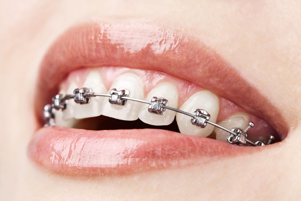 Learning Braces vs. Liners in Dental Hygienist School Toronto