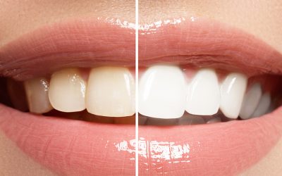 Get to Learn the History of Tooth Whitening