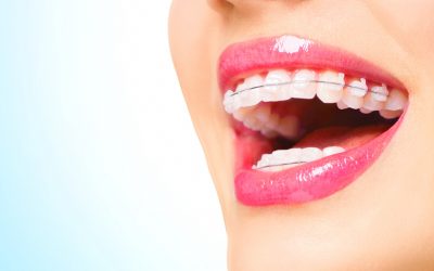 What You Learn About Braces at the Dental Hygienist School